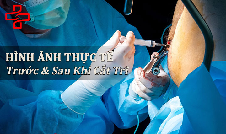Hình ảnh thực tế trước và sau khi cắt trĩ