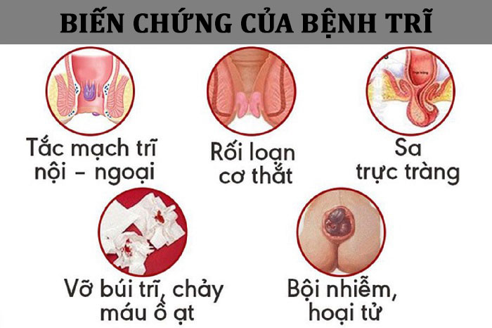 Hình ảnh thực tế biến chứng của bệnh trĩ