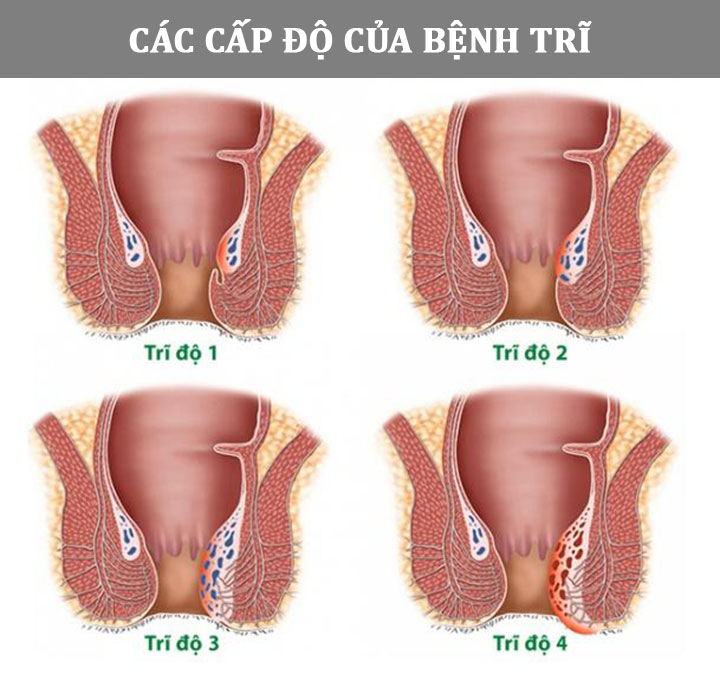 Hình ảnh thực tế các cấp độ của bệnh trĩ