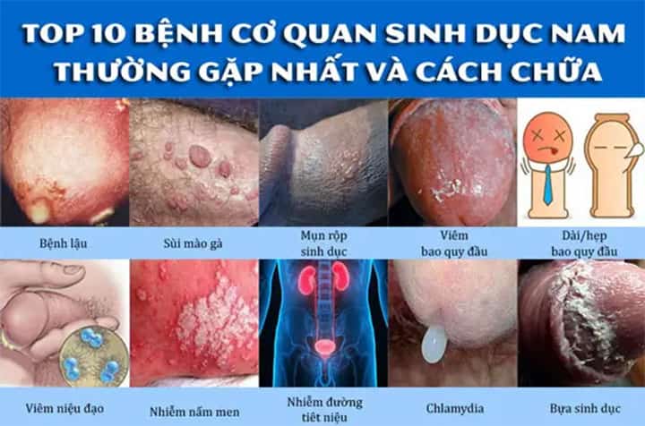 Các bệnh cơ quan sinh dục nam giới - Thường gặp