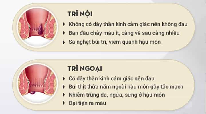 Bệnh trĩ là gì? Đừng chủ quan vì mức độ nguy hiểm nhiều người đang bỏ qua!