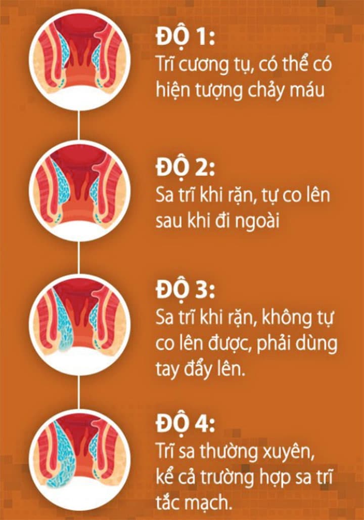 Phương pháp điều trị bệnh trĩ hiệu quả hiện nay tại 52 Nguyễn Trãi - Hà Nội