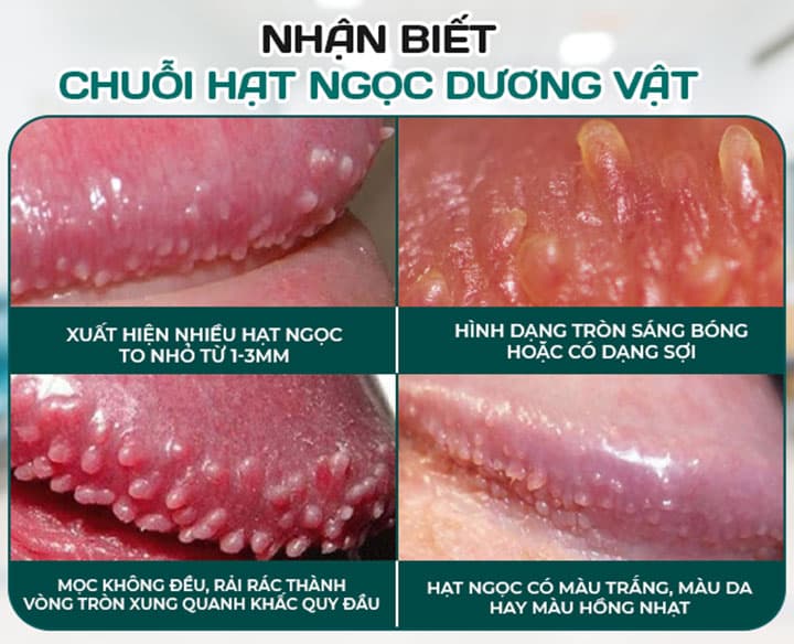 Cách chữa chuỗi hạt ngọc tại nhà như thế nào hiệu quả?