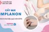 Cấy que tránh thai: Phương pháp, chi phí và địa chỉ cấy que tại Hà Nội