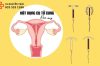Đặt vòng tránh thai có hại cho sức khỏe không?
