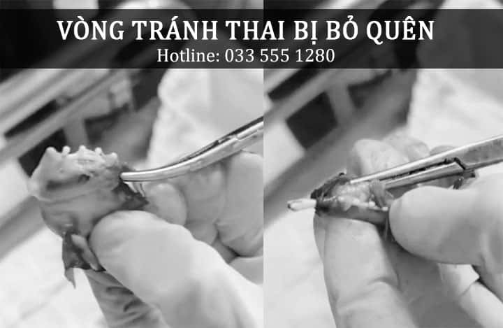 Những trường hợp nên thực hiện tháo vòng tránh thai