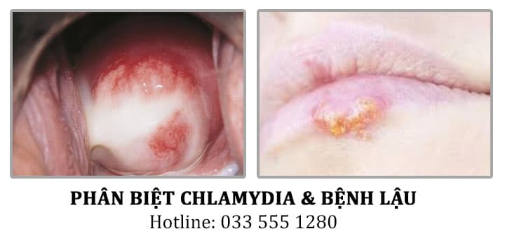 Vì sao cần xét nghiệm Chlamydia và Lậu sớm?