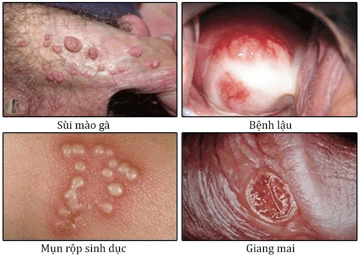Tại sao cần xét nghiệm STI/STD phát hiện các bệnh lây truyền qua đường tình dục?