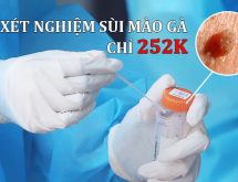 Xét nghiệm sùi mào gà chỉ 252.000 đồng tại Hà Nội