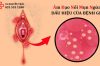 Âm đạo nổi mụn ngứa là dấu hiệu của bệnh gi?