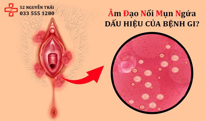 Âm đạo nổi mụn ngứa là dấu hiệu của bệnh gi?