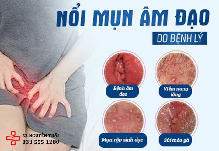 10 Nguyên nhân khiến âm đạo nổi mụn ngứa