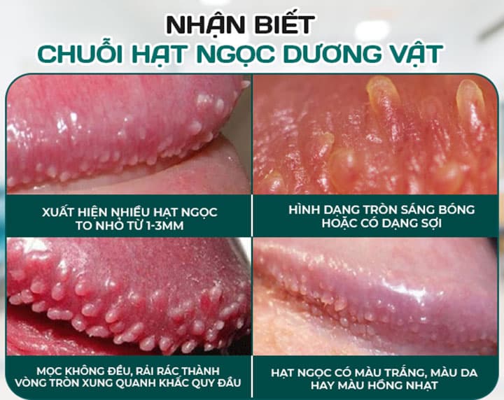 Chuỗi hạt ngọc dương vật là một hiện tượng sinh lý lành tính