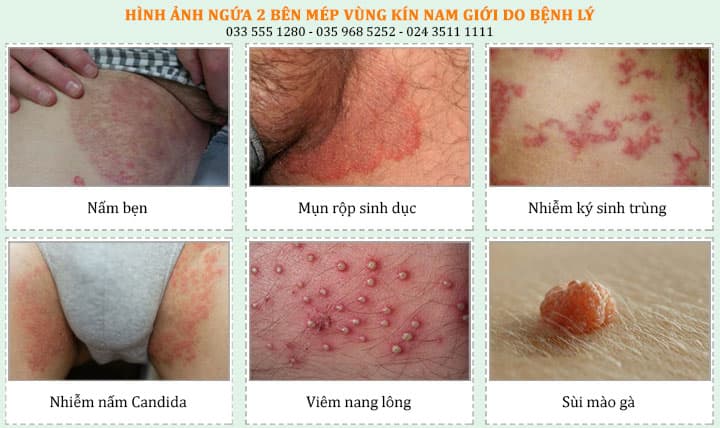 Nguyên nhân khiến nam giới bị ngứa 2 bên mép vùng kín