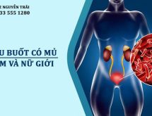Tiểu buốt có mủ: Cảnh báo bệnh lây qua đường tình dục