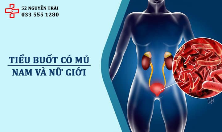 Tiểu buốt có mủ: Cảnh báo bệnh lây qua đường tình dục