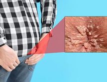 Mụn Cóc Ở Hậu Môn: Dấu Hiệu, Nguy Cơ Tiềm Ẩn Và Cách Điều Trị