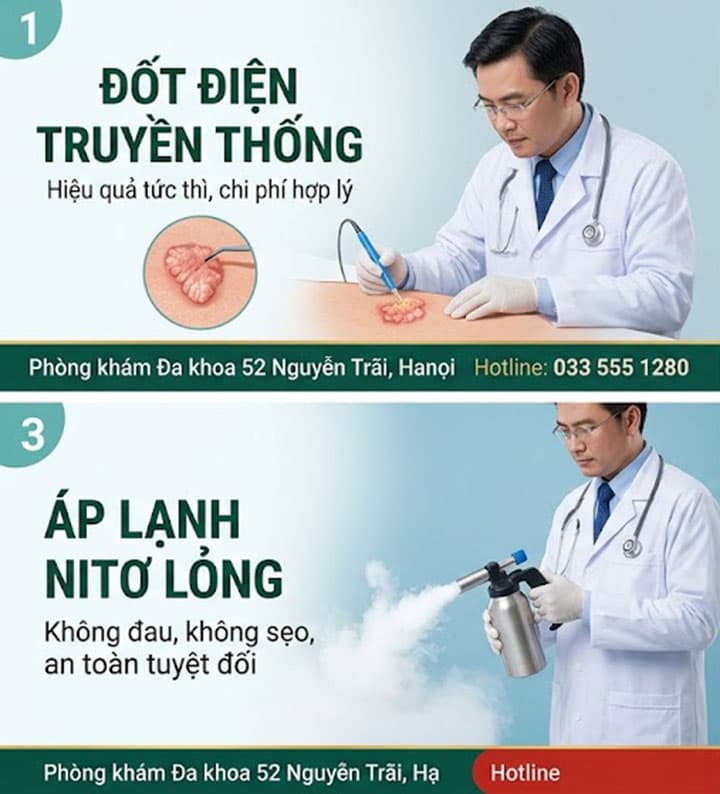 Các phương pháp đốt sùi mào gà phổ biến nhất hiện nay